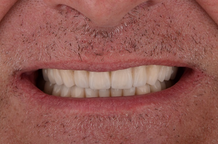 Rezultat tretmana SigmaDent 1